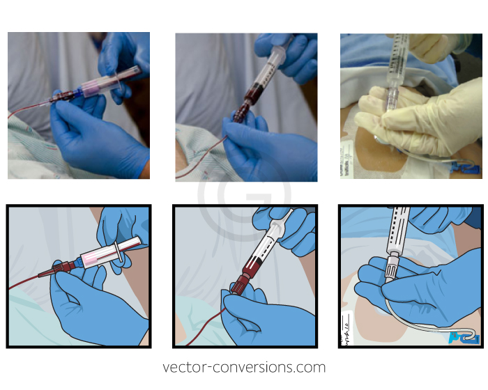 Vector drawing of medical procedure for instruction manual